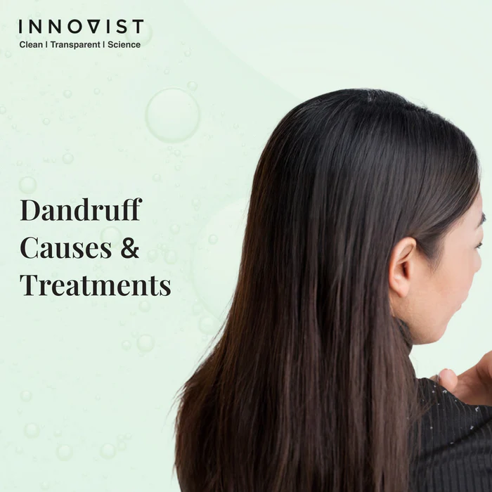 Home dandruff causes treatments 1